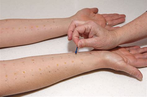 scratch test dermatology|scratch skin test patient teaching.